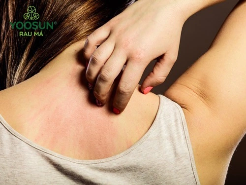 bị rôm sảy có phải mang thai không