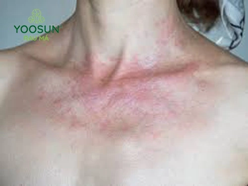 rôm sảy ở phụ nữ mang thai