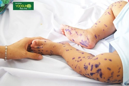 Bé bị thủy đậu bao lâu thì khỏi
