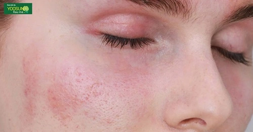 Nấm da mặt: Nguyên nhân, biểu hiện và cách điều trị