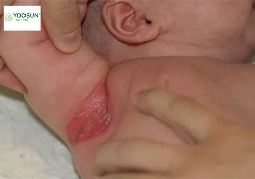 Bị hăm ở nách phải làm sao