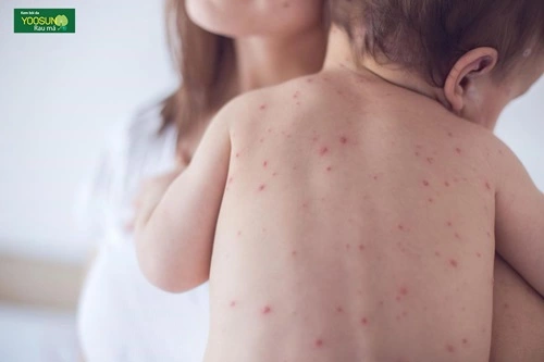 Dấu hiệu bệnh thuỷ đậu ở trẻ nhỏ