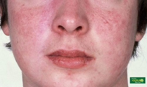 Nấm da mặt: Nguyên nhân, biểu hiện & cách trị nấm da mặt tại nhà