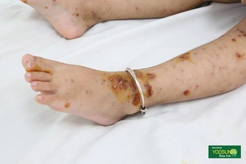 Trẻ bị thuỷ đậu có nguy hiểm không