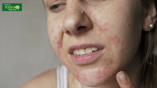 Bị ngứa da mặt như kiến bò