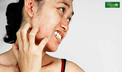 Bị ngứa da mặt nhưng không nổi mụn