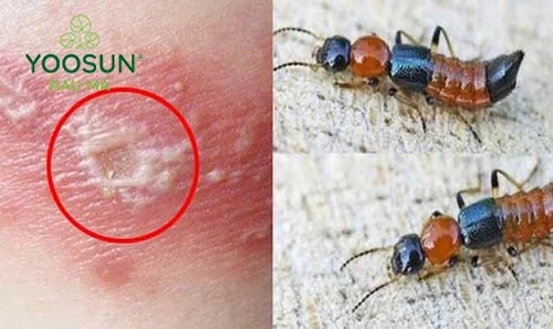 Biến chứng khi bị côn trùng cắn