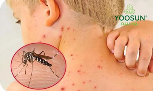 Biểu hiện khi bị côn trùng đốt