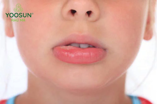 Côn trùng cắn khi nào gặp bác sĩ 