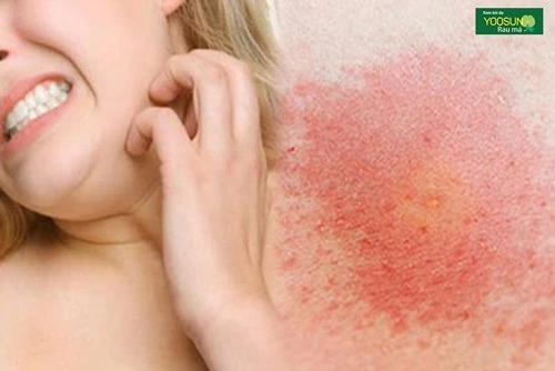 Da mặt bị ngứa và sần sùi