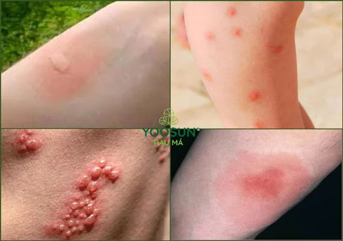 Dấu hiệu bị côn trùng cắn 