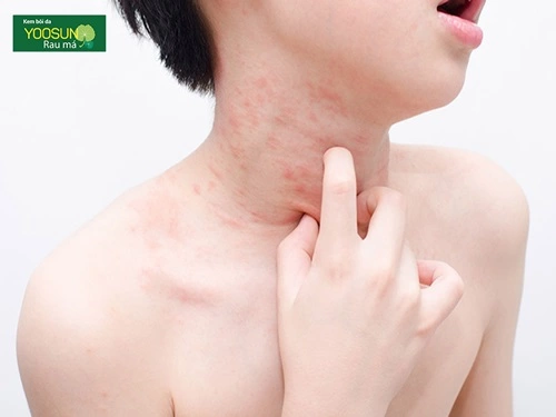 Bị ngứa da cổ là bệnh gì