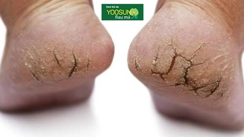 Bệnh chai gót chân là bệnh gì