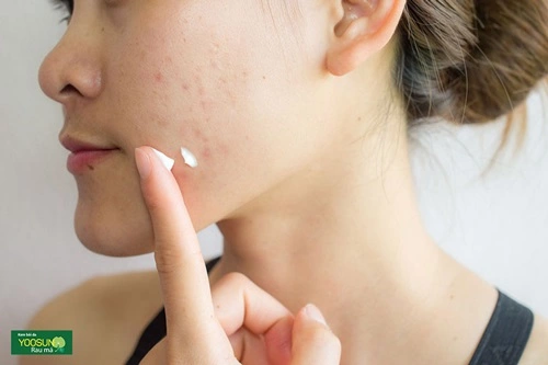 Cách chữa da bị nhiễm demodex