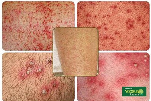 Da nhiễm demodex là gì