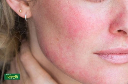 triệu chứng da bị nhiễm demodex