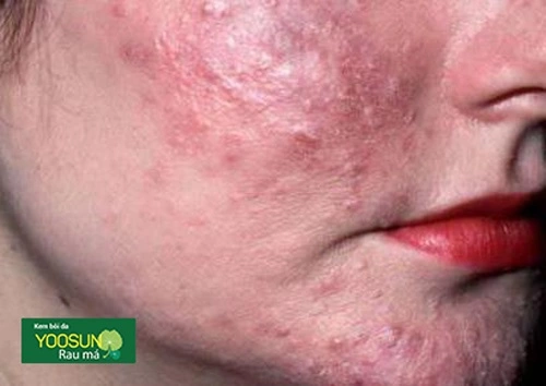 viêm da do demodex