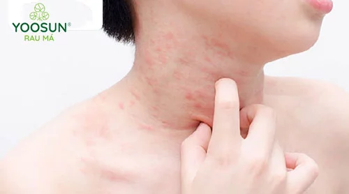 Nguyên nhân nổi sảy ở cổ người lớn
