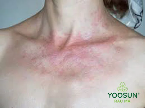 Nổi sảy trên cổ