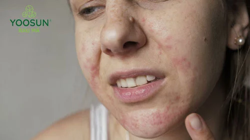 Nổi sảy trên mặt người lớn