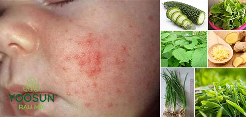 Rôm sảy ở mặt trẻ sơ sinh