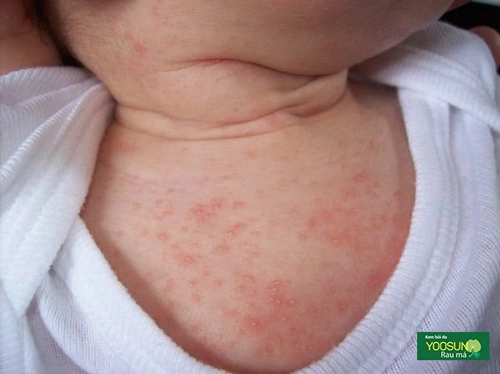 Trẻ bị rôm sảy ở cổ phải làm sao