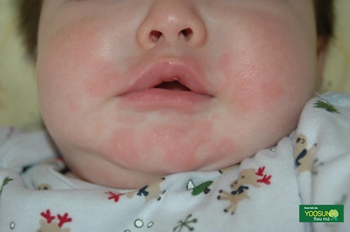 Trẻ bị rôm sảy ở mặt