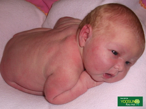 Trẻ sơ sinh bị nổi sảy trên mặt