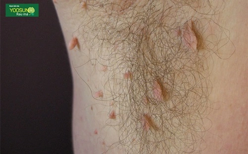 Bị mọc mụn thịt ở nách