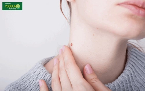 Bị mụn thịt ở cổ là bệnh gì