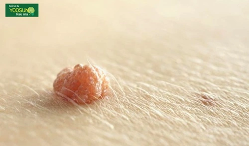 Da bị nổi mụn thịt ở cổ có lây không