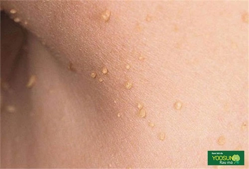 Hình ảnh mụn thịt ở cổ 