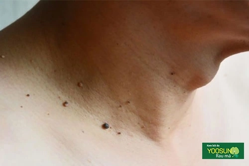 Lên mụn thịt ở cổ có nguy hiểm không