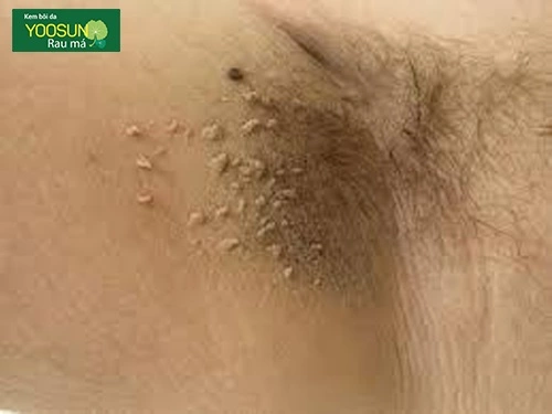 Mụn thịt dư ở nách