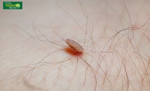 Nổi mụn thịt thừa ở nách