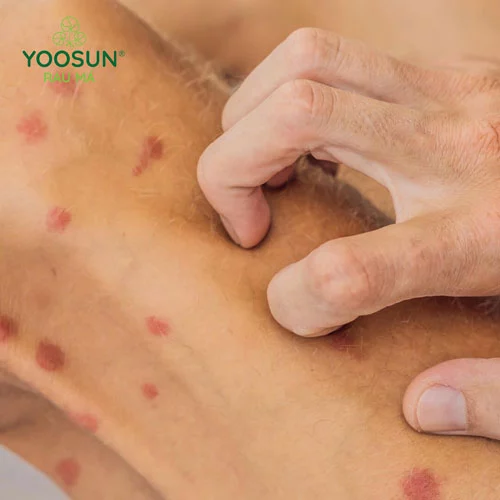 Dị ứng với kem body