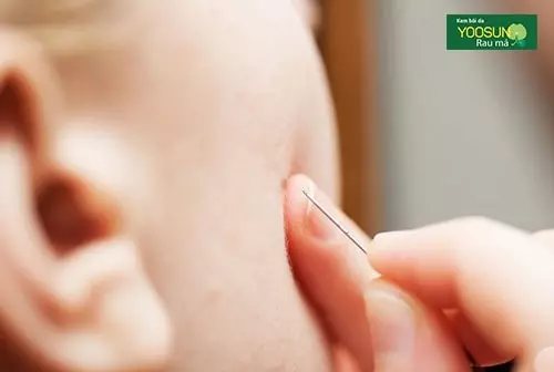 Bị mụn thịt có thể lây không mụn thịt có thể lây không