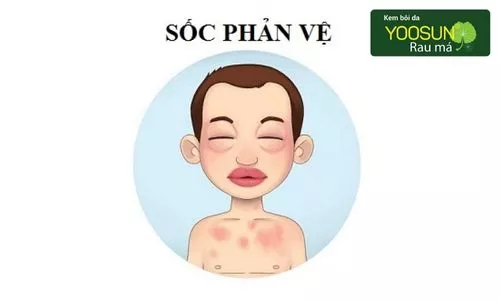 dị ứng cồn 70 độ