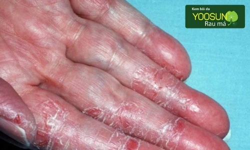 bị dị ứng dầu máy