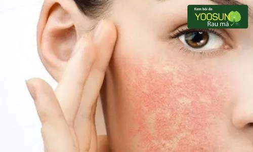 Cách nhận biết da dị ứng với cồn