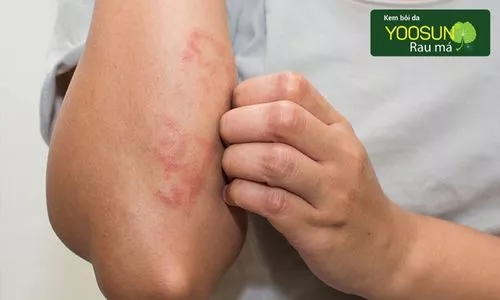 Dị ứng cồn sát khuẩn