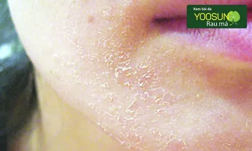 dị ứng cồn y tế