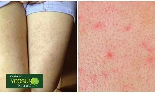 Bị viêm nang lông chân là gì