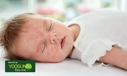 Bị viêm nang lông trên mặt