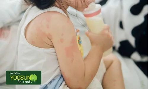 biểu hiện dị ứng lông chó mèo