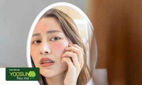 Bị dị ứng nước mưa là bệnh gì? Biểu hiện và cách xử lý