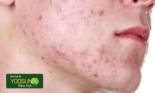 hình ảnh viêm nang lông ở mặt gây mụn