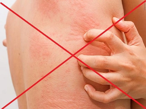 bị mề đay có nằm quạt được không