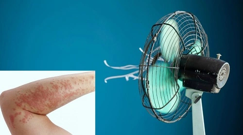 bị nổi mề đay có được nằm quạt không