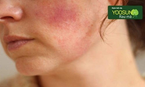 dị ứng nước tẩy trang bioderma